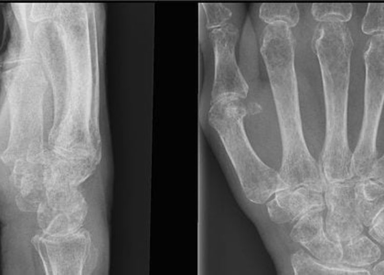 Statin therapy does not prevent osteoporotic fractures [JUPITER trial]