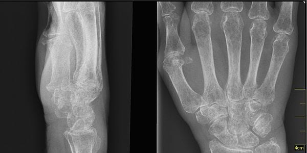 osteoporosis
