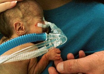 No decrease in infant mortality with maternal micronutrient supplementation in Bangladesh