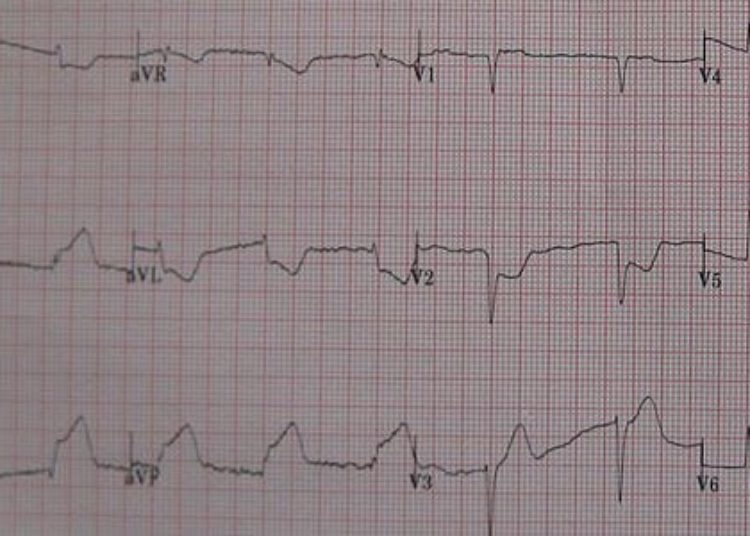 Reperfusion therapy may be suboptimal for STEMIs requiring transfers