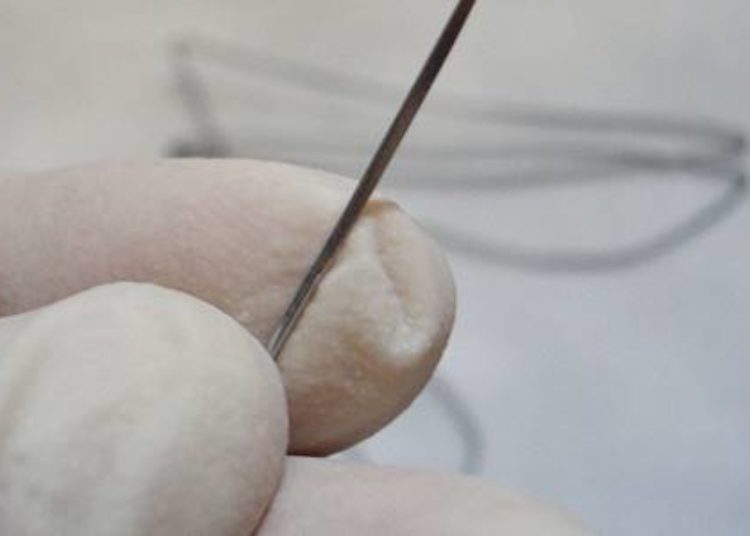 Less wound complications with suture skin closure after C-section
