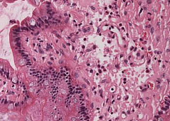 Amyloidogenic genetic variant not associated with increased mortality in blacks