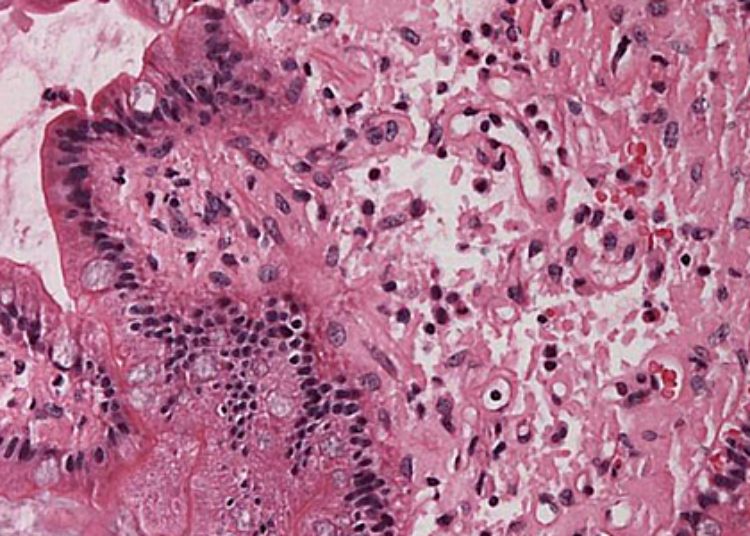 Amyloidogenic genetic variant not associated with increased mortality in blacks