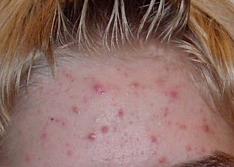 Standardized measures effectively tracked psoriasis and acne outcomes