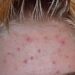 Standardized measures effectively tracked psoriasis and acne outcomes