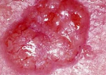 Increased risk of non-melanoma skin cancer with subsequent keratinocytes carcinoma