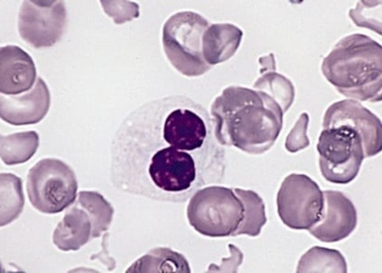 Genetic mutation identified that underlies familial myelodysplastic syndrome [PreClinical]