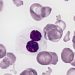 Genetic mutation identified that underlies familial myelodysplastic syndrome [PreClinical]
