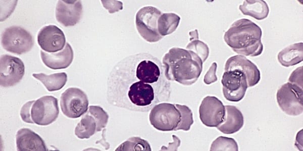 Hypogranular_neutrophil_with_a_pseudo-Pelger-Huet_nucleus_in_MDS
