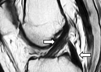 Hamstring tendons often regenerate after harvest for ACL repair