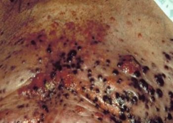 Melanoma immunohistochemical analysis useful to determine BRAFV600E mutation status