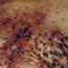 Melanoma immunohistochemical analysis useful to determine BRAFV600E mutation status