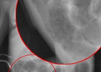 Deaths of extremely premature infants decrease, necrotizing enterocolitis deaths on the rise