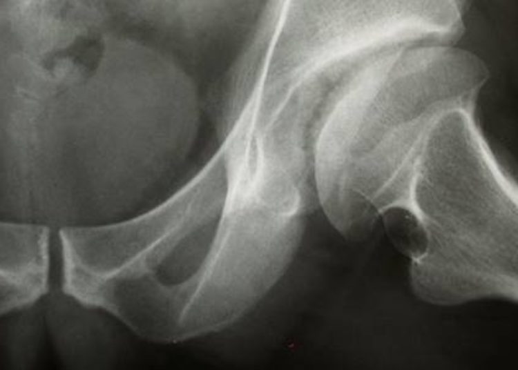 MRI screening may improve osteonecrosis outcomes in children with leukemia