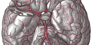 Perfusion-guided endovascular stroke treatment improves outcomes