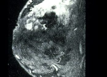 Incidental findings common with breast imaging, often benign