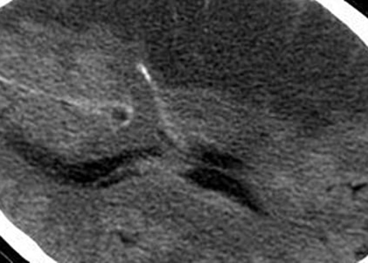 Stroke expansion following intra-arterial therapy may explain worse outcomes