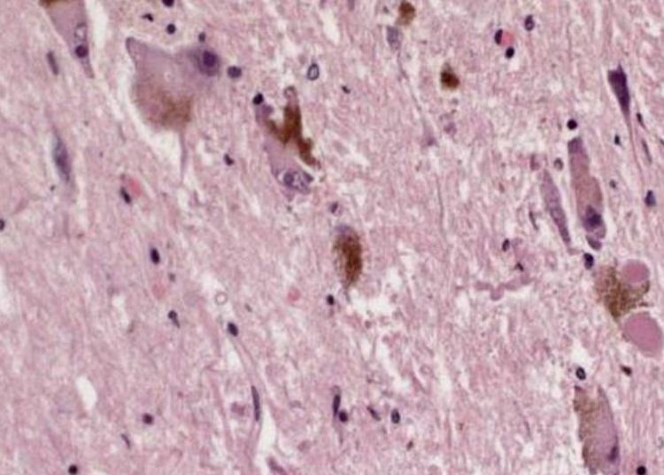 Diffusion tensor imaging may aid in Parkinson’s diagnosis