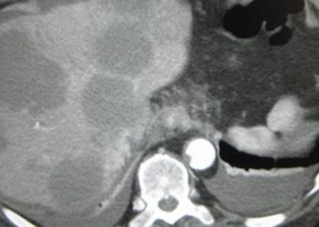 Resection of colorectal liver metastases may improve cost and longevity