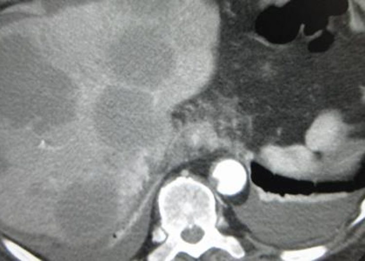 Resection of colorectal liver metastases may improve cost and longevity
