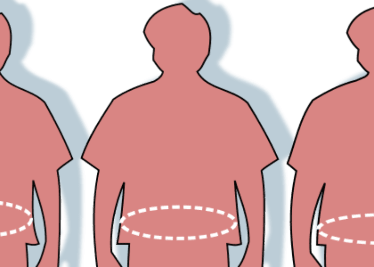 Bariatric surgery linked to decreased all-cause mortality