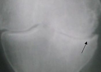 Intra-articular injection therapies most effective at controlling knee osteoarthritis pain