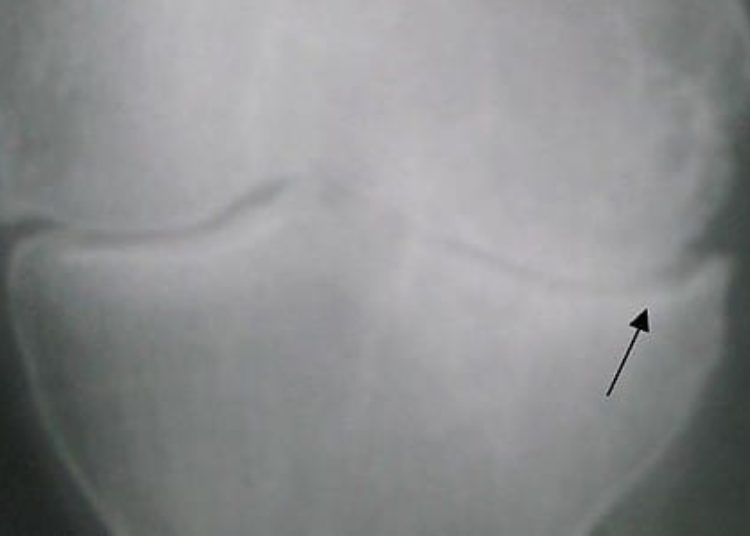 Intra-articular injection therapies most effective at controlling knee osteoarthritis pain