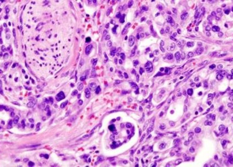Hypoxia biomarker may predict distant recurrence in pancreatic cancer