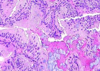 Radiation plus hormone therapy may improve prostate cancer survival