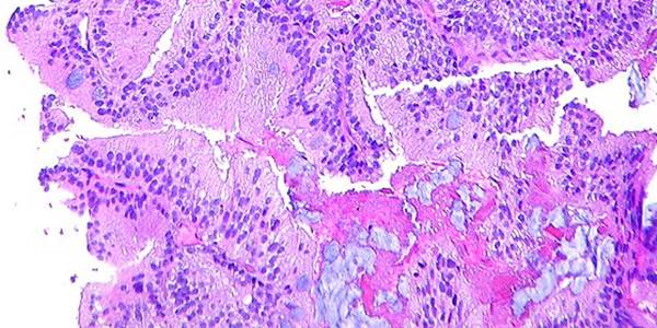 prostatecancer_edited