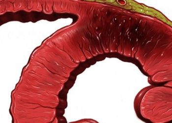 Reinnervation of cardiac infarcts decreases subsequent arrhythmia incidence [PreClinical]