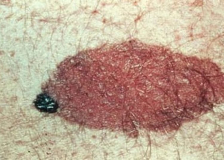 Increased risk of subsequent melanoma after first melanoma diagnosis