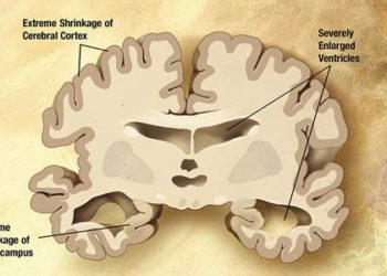 Amyloid may cause distant cerebral hypometabolism in Alzheimer’s