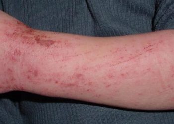 Topical pimecrolimus use for atopic dermatitis not linked to malignancy