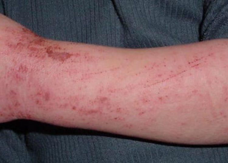 Topical pimecrolimus use for atopic dermatitis not linked to malignancy