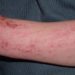 Topical pimecrolimus use for atopic dermatitis not linked to malignancy