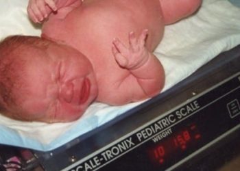 Bariatric surgery before pregnancy linked to lower risk of gestational diabetes