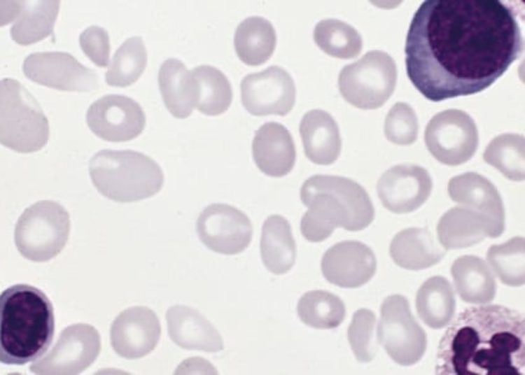 JAK2 and TET2 mutations temporally linked with myeloproliferative disorder outcomes