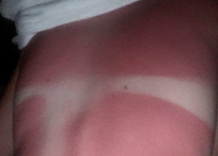 Sun protection advice from smartphone app may decrease sun exposure