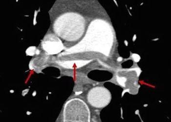 Ultrasound-accelerated thrombolysis may improve pulmonary embolism outcomes