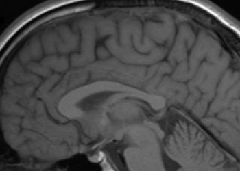 Combined MRI and NIH stroke scores may predict stroke prognosis