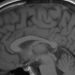 Combined MRI and NIH stroke scores may predict stroke prognosis