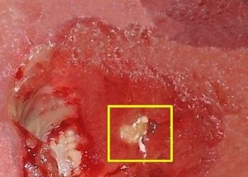 Fortified formula promotes pressure ulcer healing