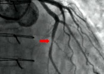 Appropriate use criteria for angiography may frequently miss obstructive coronary artery disease