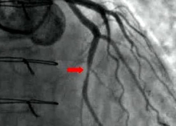 Appropriate use criteria for angiography may frequently miss obstructive coronary artery disease