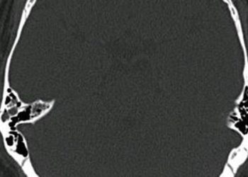 Use of CT for adult fall patients is rising in the emergency department