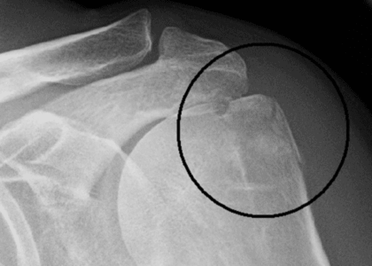 Surgical vs. non-surgical treatment of humeral fractures similar in outcome