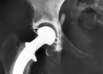 Shorter hospital stays after hip fracture linked to greater risk of short-term death