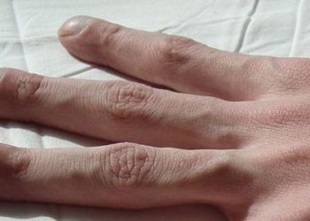 Novel compound may correct pathological airway mucus in cystic fibrosis [PreClinical]