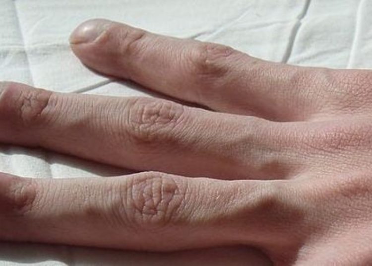 Novel compound may correct pathological airway mucus in cystic fibrosis [PreClinical]